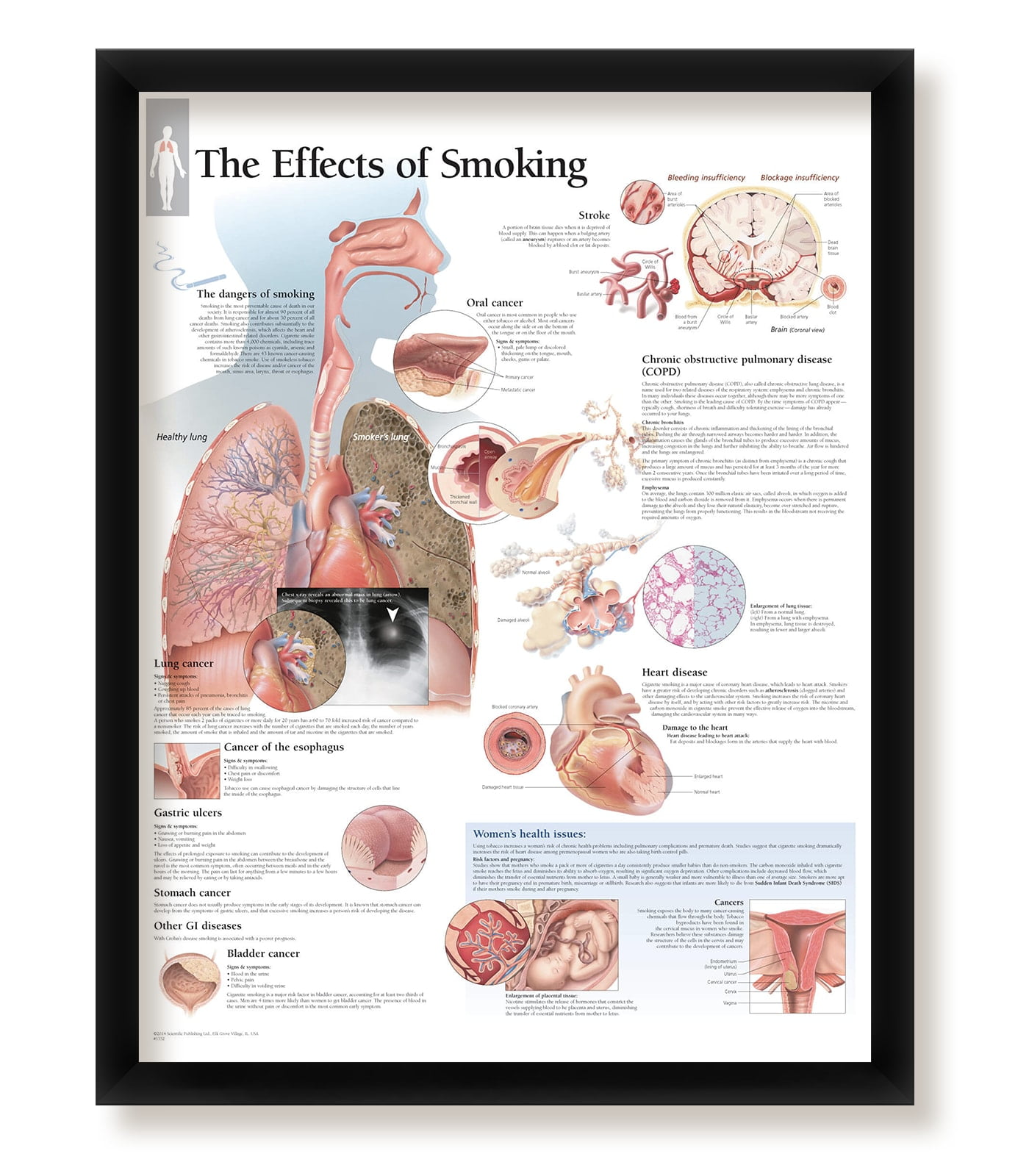 the effect of mixing alcohol and tobacco poster Set of 3 Framed Medical Posters The Effects of Alcohol The Effects of  Smoking and Understanding Nutrition 22