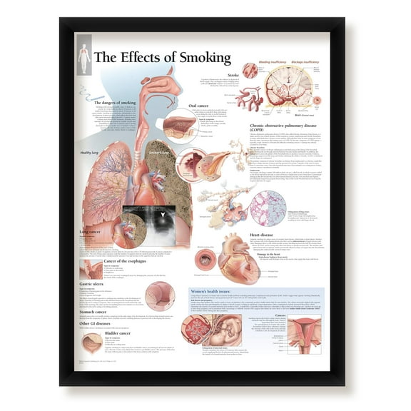 The Effects of Smoking Framed Medical Educational Informational Poster Diagram Doctors Office School Classroom 22x28 Inches