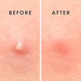 thumbnail image 4 of Miracle Invisible Spot Concealer - Absorbent Concealer, Skin Care, Face Stickers, 2 Sizes (96 pcs), 4 of 5