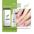 DssFDGR Varicose Veins Care Spray Get Rid of Legs and Experience From