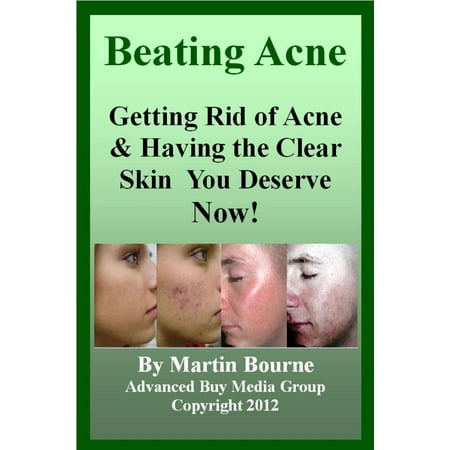 Beating Acne: Getting Rid of Acne & Having the Skin You Deserve Now! -