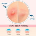 thumbnail image 5 of OUKEYA Hydro Clear Patches for Sensitive Skin Overnight Treatment 36 Pcs, 5 of 8