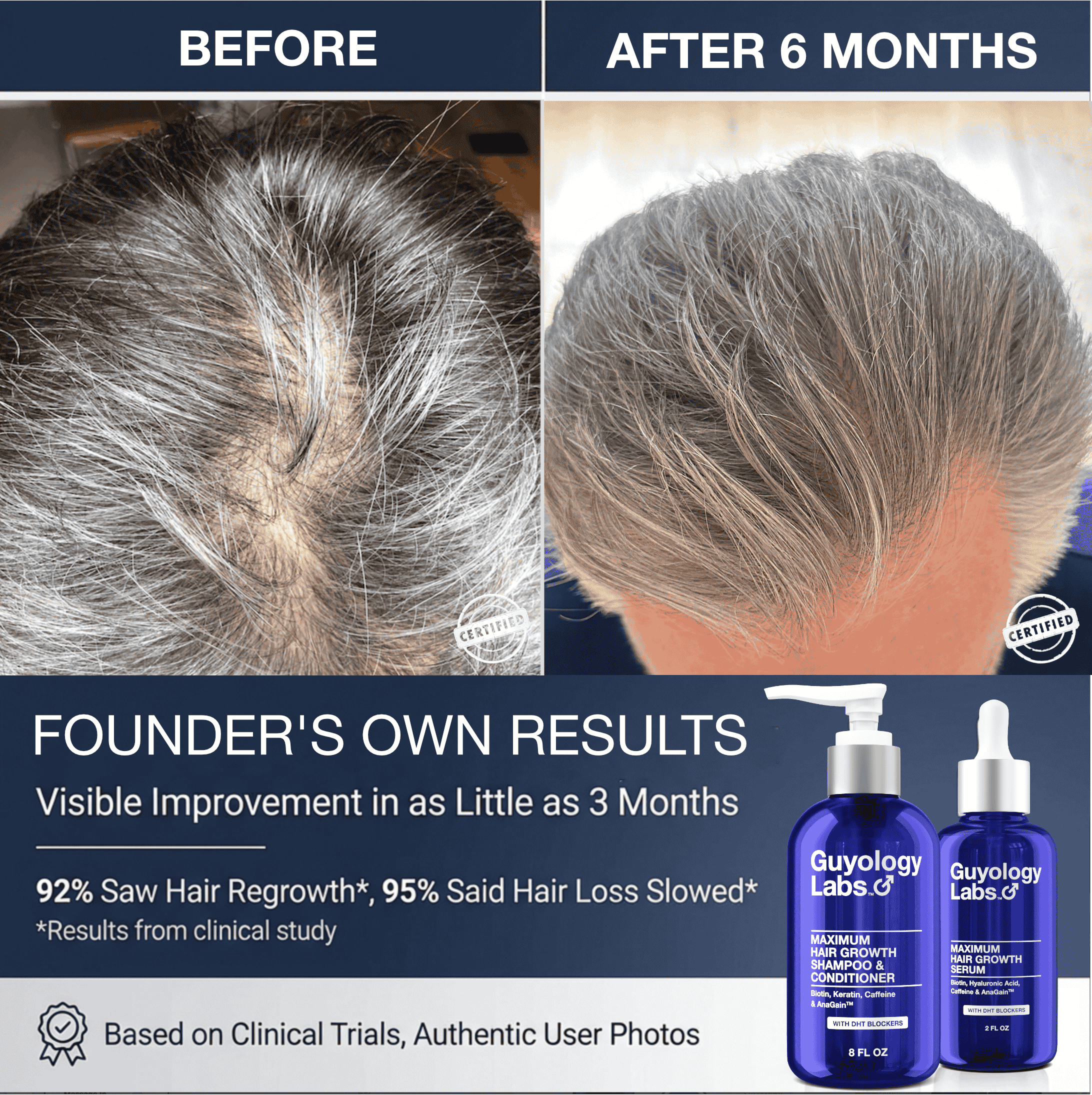 Hair Growth Shampoo and Conditioner for Men and Women DHT Blocker for Hair Loss and Regrowth Thickening Thinning Hair 2percent AnaGain™, Biotin and Caffeine Minoxidil Compatible by Guyology Labs