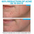 thumbnail image 3 of Crema de tratamiento de manchas La Roche-Posay Effaclar Duo 20 ml, 3 of 9