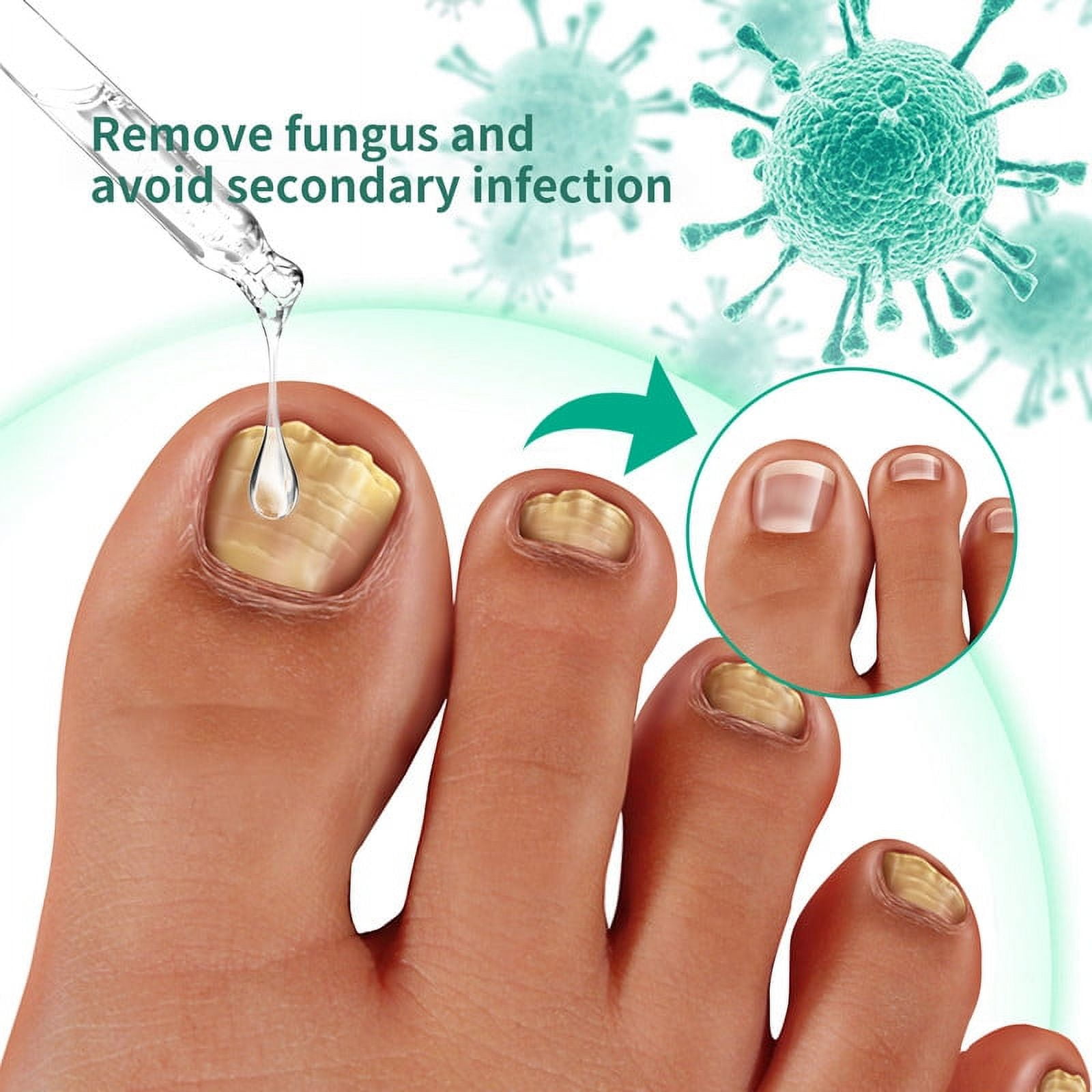 Kerassentials Toenail Treatment Oil, Kerasentials Toenail Nail Treatment for Damaged and Discolored Nails, Nail Treatment Drop For Fungal Infections(3 pcs)