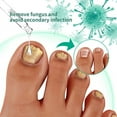 thumbnail image 4 of Kerassentials Toenail Treatment Oil, Kerasentials Toenail Nail Treatment for Damaged and Discolored Nails, Nail Treatment Drop For Fungal Infections(3 pcs), 4 of 8