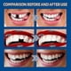 thumbnail image 4 of False Teeth Solid Glue Temporary Tooth Repair Kit Moldable Thermal Fitting Teeth Pellet -, 4 of 4