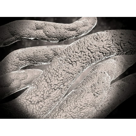 Microscopic view of corncob formation in dental plaque Canvas Art - Stocktrek Images (17 x 13)