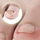 thumbnail image 4 of Dispositivo para corregir uña encarnada, rizar uñas, corregir dedos del pie y corrector facial., 4 of 5