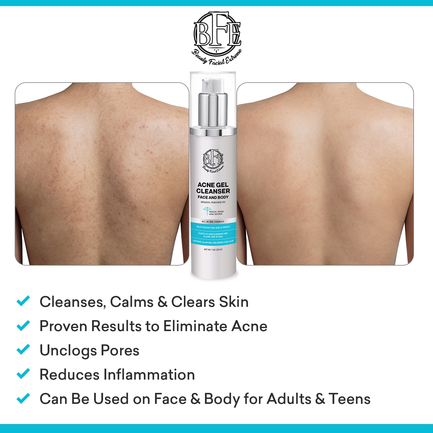 Acne Face Wash Treatment with Benzoyl Peroxide 5 Precent - Fight Acne Blemishes on Contact for Cystic Breakouts, Oily Skin, Clogged Pores, Blackhead, Whitehead & Pimples