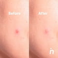 thumbnail image 3 of Parches Para Granos Acne De Hidrocoloides Nipskin 9 Piezas, 3 of 6