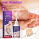 thumbnail image 2 of Corn Removal Extra Strengthen Gel Foot Callus Removal Treatment Hard Skin, 2 of 5