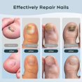 thumbnail image 5 of Nail-Fungus Lasers Device, Device for Multiple Toenails Fingernails, Effectively Addressing Weak Damage Nails For Home Use, 5 of 5