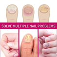 thumbnail image 4 of Ginger Nail Treatment - Nail Fungus Removal, Nail Fungus Treatment for Toenail Strengthens and Smooths Cracked Nail Surface, Ginger Nail Essence Repai, 4 of 5