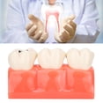 thumbnail image 4 of Teeth Caries Model, Simulation Teeth Caries Model Clear Display Excellent Texture Practical And Exquisite  For Family For Home, 4 of 8