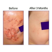 BIOCORNEUM Advanced Scar Cream Treatment Gel 50gr 1.73 OZ