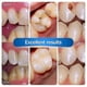 thumbnail image 4 of Teeth Resin Tooth Repair Dental Cement Cavity Filling Strong Repair Restoration - Jk, 4 of 5