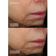 thumbnail image 5 of Skin 2.0 Parches debajo de los ojos con ácido hialurónico y colágeno - Hidratante probado por dermatólogos reduce las bolsas y arrugas - Belleza limpia antienvejecimiento Cuidado de la piel coreano si, 5 of 5
