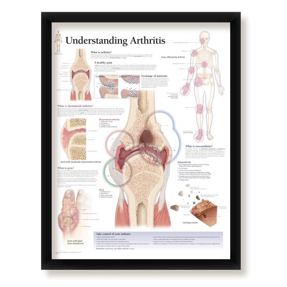 Understanding Arthritis Framed Medical Educational Poster Informational Diagram Doctors Office School Classroom 22x28 Inches