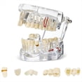 thumbnail image 1 of Modelo de Dientes Enfermos Tipodontos Dentales Modelo de Dientes de Implante con Dientes Removibles Demostración de Dientes Estándar del Dentista, 1 of 5
