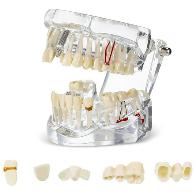 Modelo de Dientes Enfermos Tipodontos Dentales Modelo de Dientes de Implante con Dientes Removibles Demostración de Dientes Estándar del Dentista