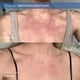 thumbnail image 2 of Bálsamo para aliviar el eccema Skinfix Eczema+ Dermatitis 50 ml, 2 of 6