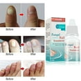 Lanthome Fungal Liquid Nail Treatment Nail And Foot Whitening Toenail