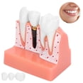 thumbnail image 4 of Modelo De Análisis De Implantes Dentales, Material De Resina Conveniente Demostración De Extracción Demostración Del Modelo De Diente Aprendizaje Del Estudiante Para, 4 of 7