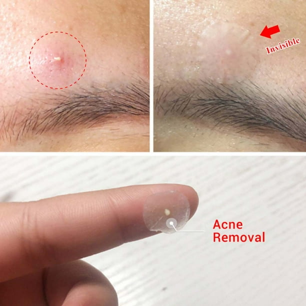 Parche De Grano, 36 Piezas/hojas De Ocultación De Hojas, Ocultando El Parche De Pegatina Que Cubre La Espinilla Transparente Para Las Espinillas Ocultas De Las Huelgas De La Etapa