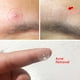 thumbnail image 1 of Parche De Grano, 36 Piezas/hojas De Ocultación De Hojas, Ocultando El Parche De Pegatina Que Cubre La Espinilla Transparente Para Las Espinillas Ocultas De Las Huelgas De La Etapa, 1 of 7