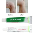 thumbnail image 2 of Ungüento para la psoriasis,dermatitis y eczema(Buy 2 Save 10%), 2 of 5
