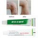 thumbnail image 2 of Clearance Sale! Skin Psoriasis Dermatitis Eczema Ointment (Buy 2 get 1 free), 2 of 8