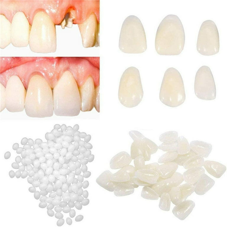 Temporary Tooth Kit for Filling The Missing Broken Tooth and Moldable Temporary Veneers Material Anterior Front Back Molar Teeth Lost Tooth Filling Partial Denture Snap on Braces for Looks Teeth Cove