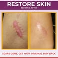 thumbnail image 7 of Medical Grade Silicone Scar Sheets – Non-Irritating Silicone Scar Strips for Surgical Scars,  Tummy Tuck & Keloid Appearance – Soft Gel Scar Sheets, 1.6 in x 60 in, 7 of 7