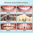 thumbnail image 5 of Raspador dental ultrasónico TUNC para sarro dental, 5 of 5