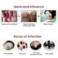 thumbnail image 5 of 1/2/3Pcs Nail Fungal Treatment Feet Care Essence Nail Foot Care Toe Nail Fungus Removal Gel Anti Infection Paronychia Onychomycosis, 5 of 5