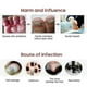 thumbnail image 5 of 1/2/3Pcs Nail Fungal Treatment Feet Care Essence Nail Foot Care Toe Nail Fungus Removal Gel Anti Infection Paronychia Onychomycosis, 5 of 5