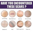 thumbnail image 2 of Silicone Scar Stickers Dilute Scars Caesarean Section Surgery Scar Hyperplasia Scar Silicone Repair Sticker, 2 of 5