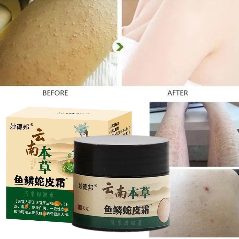 Curing Keratosis Pilaris Chicken Skin Body Lotion Skin Repair Skin