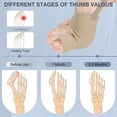 thumbnail image 3 of 2 Pcs Bunion Corrector for Women & Men, Comfortable & Breathable Toe Corrector Socks for Day/Night Support, Hallux Valgus Pain Relief, Non-Slip Big Toe Straightener, 3 of 8