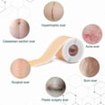 thumbnail image 4 of Self-Adhesive Silicone Scar Sheets - Medical Grade Scar Removal Patches for C-Section, Acne Scars, Keloid Surgery & Burn Scars, 4 of 5