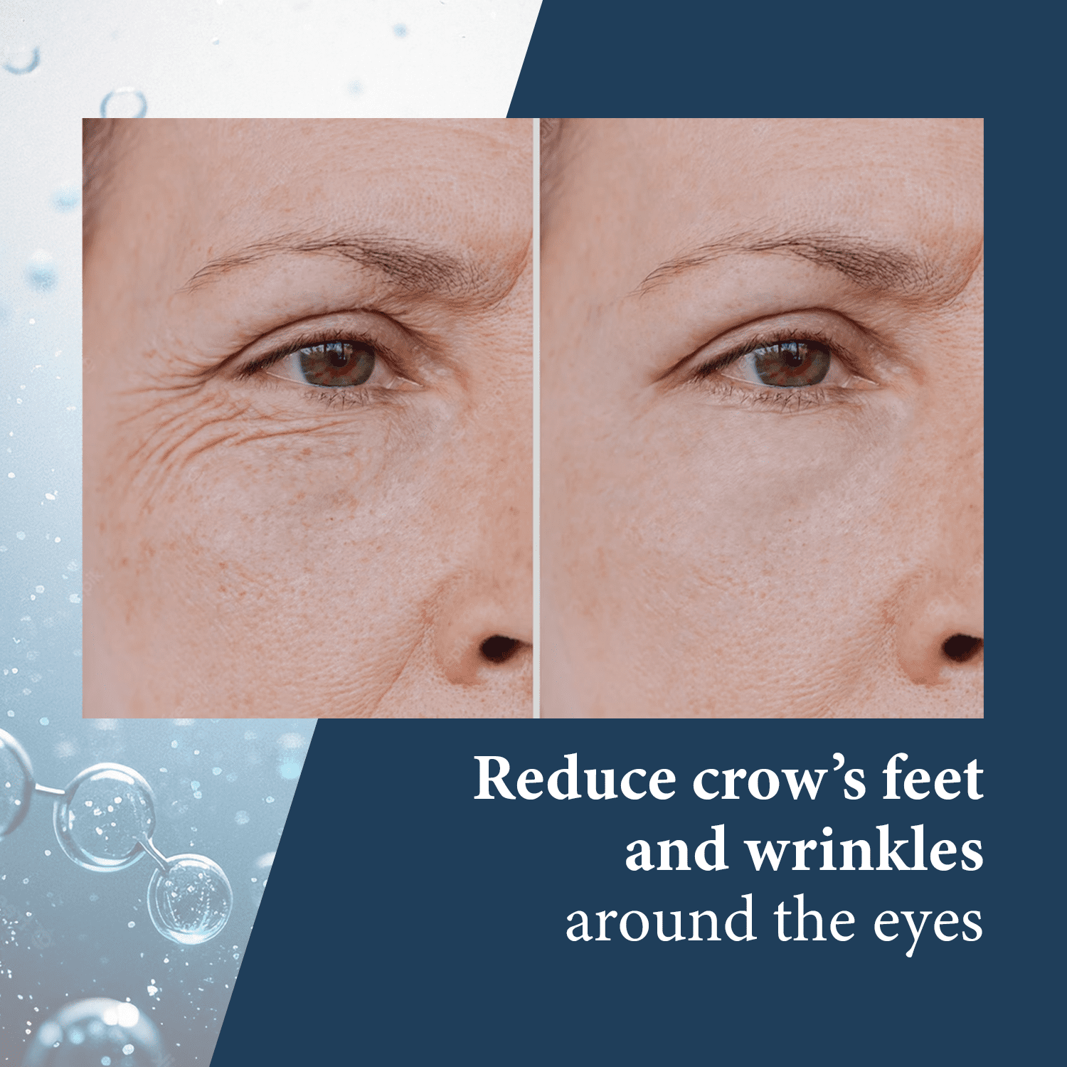 Skin Pro Elite Serum 10 - Natural Anti Aging Eye Serum and Anti Wrinkle Treatment - Eye Bags and Dark Circles Remover with Advanced Formulation of Hyaluronic Acid, Collagen, Argireline and Peptides