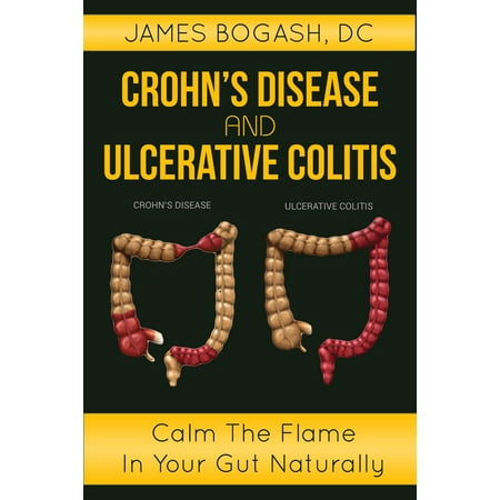 Crohn's Disease and Ulcerative Colitis: Calm the Flame in Your Gut Naturally - (Best Natural Treatment For Ulcerative Colitis)