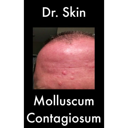 Molluscum Contagiosum - eBook (Best Way To Treat Molluscum Contagiosum)