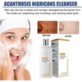 Riohave Cleansing Lotion For & Acanthosis Nigricans & Dark Natural