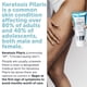thumbnail image 3 of Exfoliante corporal KP Bump Eraser, queratosis pilaris, tratamiento para mujeres, 3 of 5