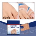 thumbnail image 4 of Corrector de juanetes ajustable y cómodo para soporte de dedos de día y de noche, modelo Toward Platinum, 4 of 9