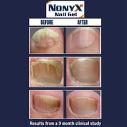 NonyX Nail Gel 4 Oz (Pack of 9)