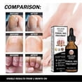 thumbnail image 2 of Fungal Nail Treatment Oil Nail Strengthening Serum Cuticle Care Nail Repair for Fungal & Brittle Nails, 2 of 5