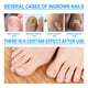 thumbnail image 2 of Parches De Corrección De Uñas Pegatinas de corrección de uñas Corrector de uñas encarnadas Parches Uñas, 2 of 8